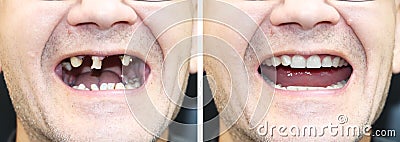 The patient at the orthodontist before and after the installation of dental implants. Tooth loss, decayed teeth, denture, veneers Stock Photo