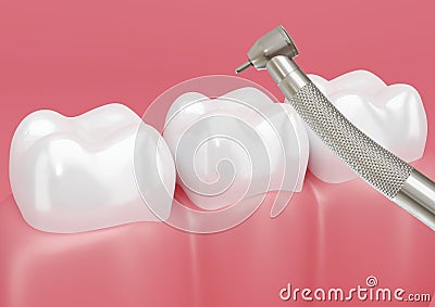 Patient`s tooth treated with dental drill to remove cavities Stock Photo