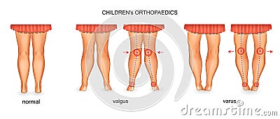 Pediatric orthopedics. valgus and varus Vector Illustration