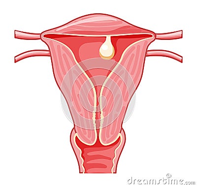 Pedunculated Polyp in the uterus Female reproductive system in cross sections. Front view in a cut. Human anatomy Vector Illustration