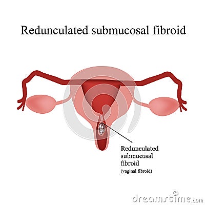 Pedunculated submucous uterine fibroids. Vaginal fibroids. Infographics. Vector illustration on background Vector Illustration