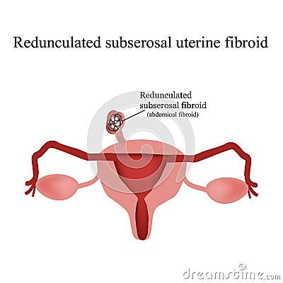 Pedunculated subserous uterine fibroids. Infographics. Vector illustration on background Vector Illustration