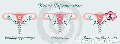 Women health - Pelvic Inflammation. Anatomical scheme of Endometritis, Oophoritis, Salpingitis. Gynecological Problems Vector Illustration