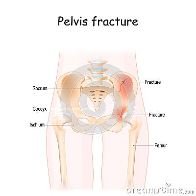 Pelvis Fracture. Vector illustration isolated on a white background Vector Illustration