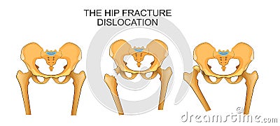 Pelvis, hip fracture. hip dislocation Vector Illustration