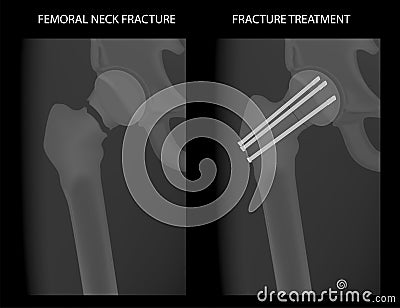 Pelvis and Hip joint problem_Femoral neck fracture treatment in young patients Vector Illustration