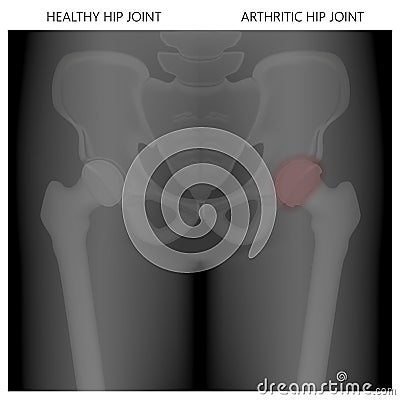 Pelvis and Hip joint problem_Pelvis Healthy and arthritic hip joints pain Vector Illustration