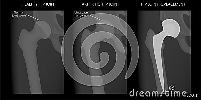 Pelvis and Hip joint problem_Healthy and arthritic hip joints and hip replacement Vector Illustration