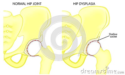 Pelvis and Hip joint problem_Hip dysplasia Vector Illustration