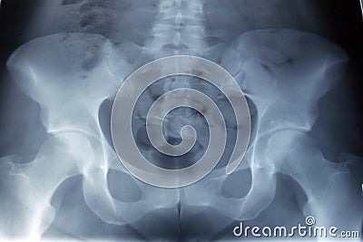 Pelvis xray Stock Photo