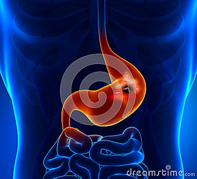 Peptic Ulcer Stock Photo