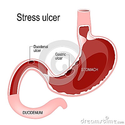 Peptic ulcer disease Vector Illustration