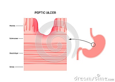 Peptic ulcer disease Vector Illustration