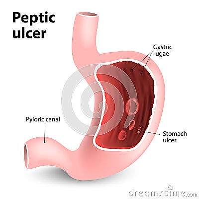 Peptic ulcer Vector Illustration