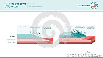 Peptic ulcer and helicobacter pylori Vector Illustration