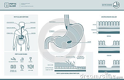 Peptic ulcer and helicobacter pylori infographic Vector Illustration