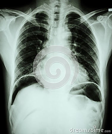 Peptic ulcer perforate . ( film chest x-ray show free air under dome of both diaphragm due to air leak from gastric ulcer or Stock Photo