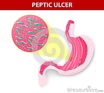 Peptic ulcer Vector Illustration