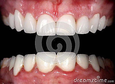 Perfect smile before and after bleaching procedure whitening of zircon arch ceramic prothesis Implants crowns. Dental restoration Stock Photo