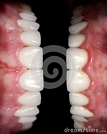 Perfect smile before and after bleaching procedure whitening of zircon arch ceramic prothesis Implants crowns. Dental restoration Stock Photo