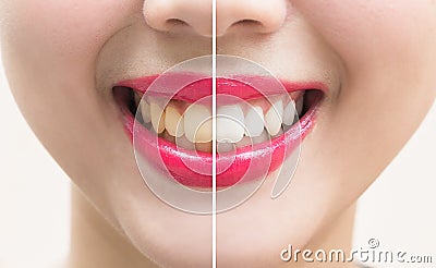 Perfect smile teeth before and after bleaching. whitening teeth Stock Photo