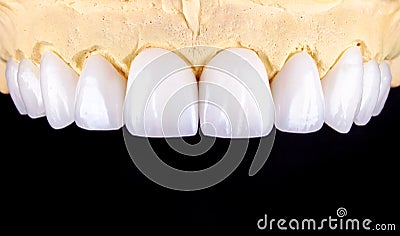 Perfect smile before and after veneers bleach of zircon arch ceramic prothesis Implants crowns. Dental restoration treatment Stock Photo