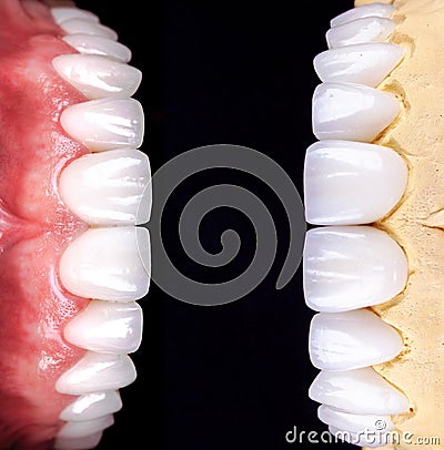 Perfect smile before and after veneers bleach of zircon arch ceramic prothesis Implants crowns. Dental restoration treatment Stock Photo