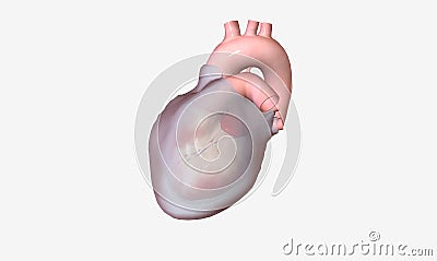 Pericardial effusion is a cardiac condition characterized by fluid buildup outside the heart Stock Photo