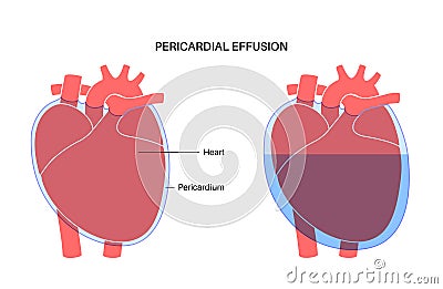 Pericardial effusion heart Vector Illustration