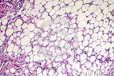 Pericarditis, light micrograph, photo under microscope Stock Photo