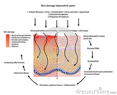 Perineal skin damage Vector Illustration