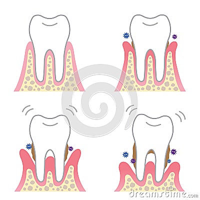 Periodontal desease Vector Illustration