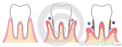 Periodontal disease Vector Illustration