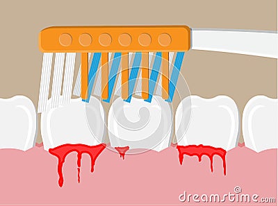 Periodontal disease, bleeding gums Vector Illustration