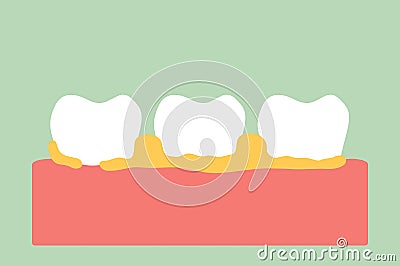 Periodontal disease with dental plaque or tartar Vector Illustration