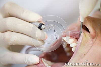 Periodontal probe for measuring pocket depths Stock Photo