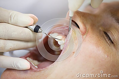 Periodontal probe for measuring pocket depths Stock Photo