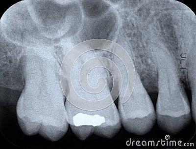 Periodontal X-ray Stock Photo