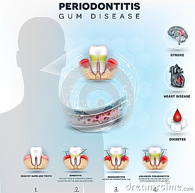 Periodontitis bacteria cause disease Vector Illustration