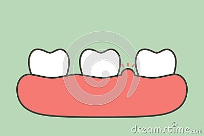 Periodontitis or gum disease with swell - teeth cartoon vector flat style Vector Illustration