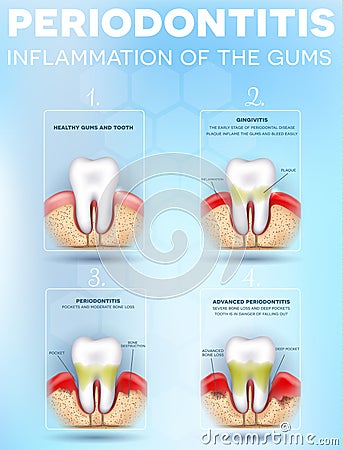 Periodontitis dental poster Vector Illustration