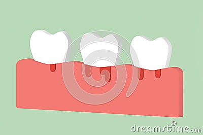 Periodontitis or periodontal disease with bleeding, inflammation of the gum tissue around the teeth Stock Photo