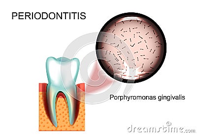 Periodontitis. Porphyromonas gingivalis Vector Illustration