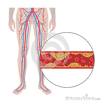 Peripheral artery disease Vector Illustration