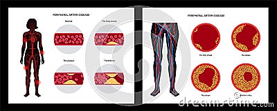 Peripheral artery disease Vector Illustration