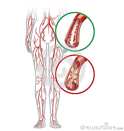 Peripheral artery occlusive disease, intermittent claudication, medical illustration Stock Photo