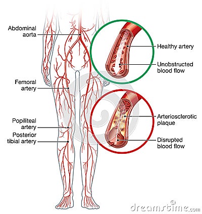 Peripheral artery occlusive disease, intermittent claudication, medical illustration Stock Photo