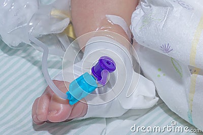 Peripheral intravenous catheter in the vein of newborn baby foot Stock Photo