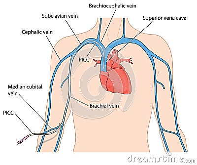 A peripherally inserted central catheter Vector Illustration