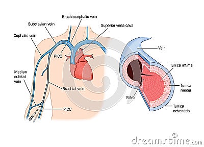 Peripherally inserted central catheter (PICC) Vector Illustration
